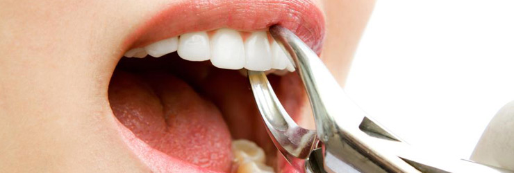 Hoppers Crossing Dentures Cost | JK Dental
