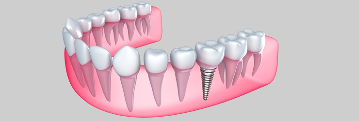 Implant | JK Dental